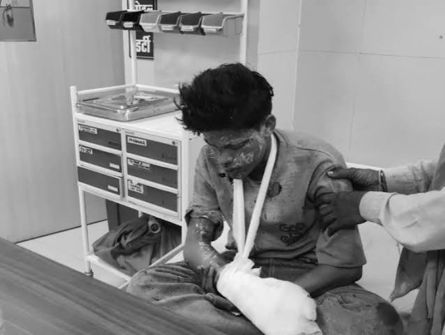 रायसेन में गज कुंडी में बारूद भरते समय विस्फोट:दो किशोर गंभीर रूप से झुलसे, सालेरा गांव की घटना; अस्पताल में इलाज जारी